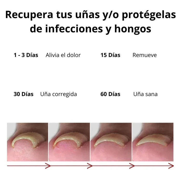 Nuevo Anti-Hongos para uñas