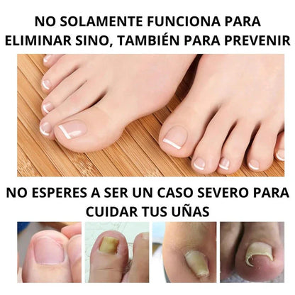 Nuevo Anti-Hongos para uñas